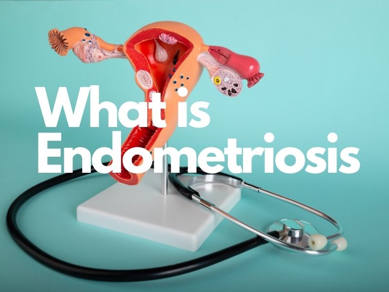 What is Endometriosis